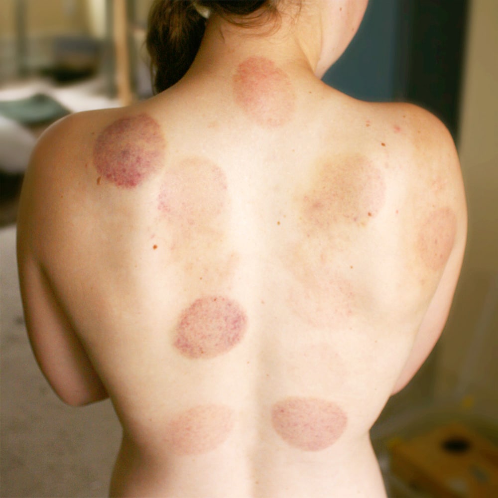 What You Need To Know: Cupping