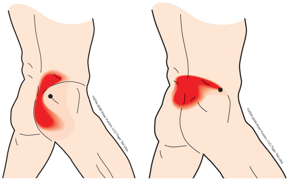 Gluteus Medius